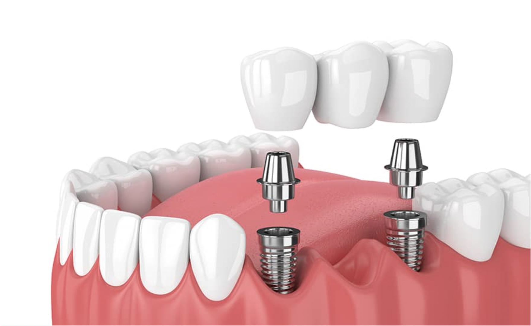 Dental implant