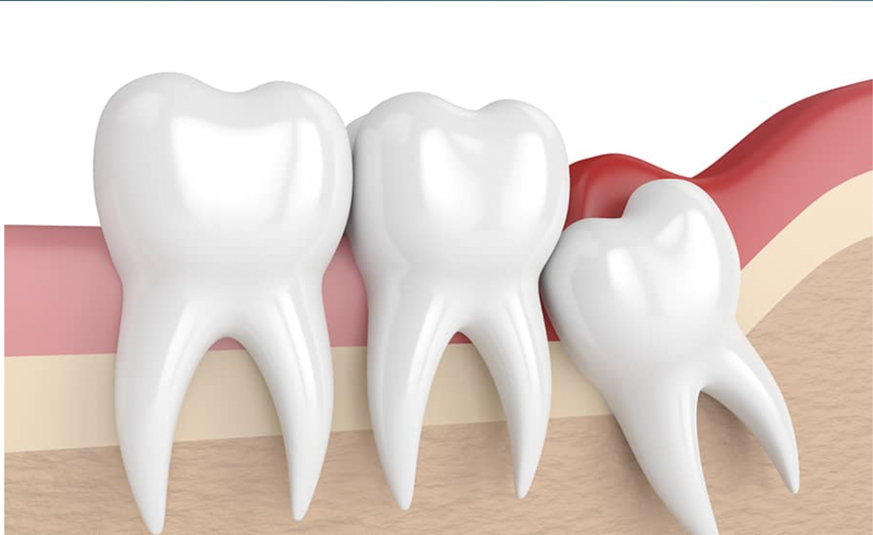 Wisdom tooth
