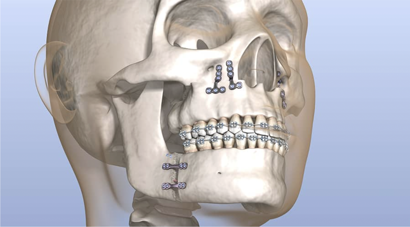 Jaw surgery