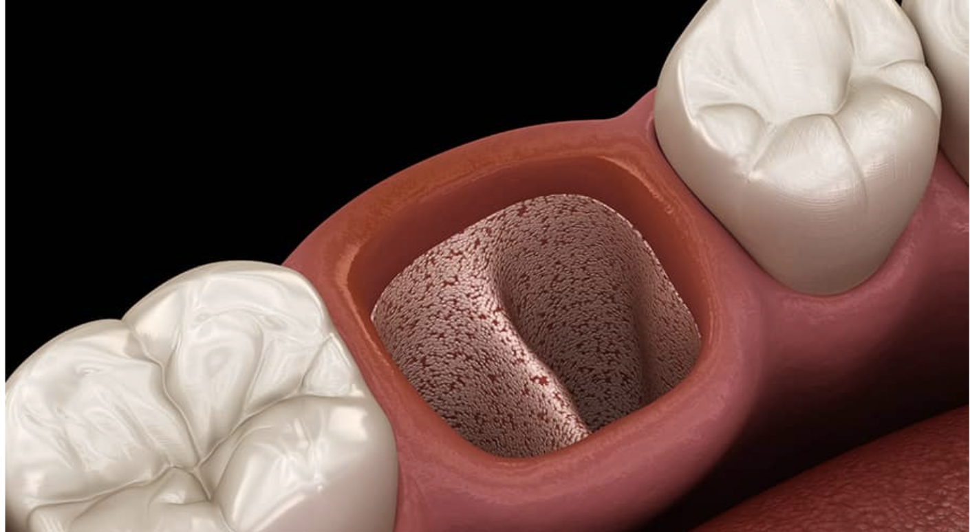Dental extraction