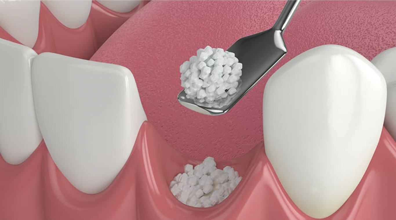 Bone grafting