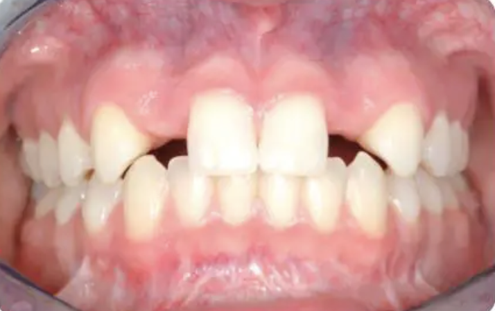 Before treatment — missing upper canines