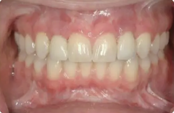 After treatment — implant restorations in place