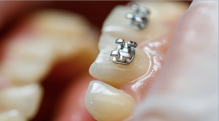 Impacted tooth exposure with orthodontic bracket