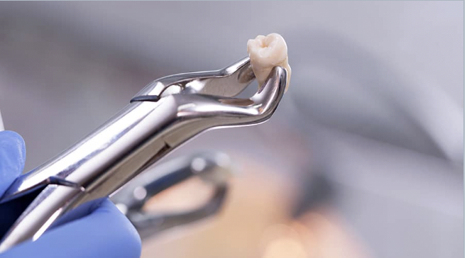 Extracted wisdom tooth held in forceps