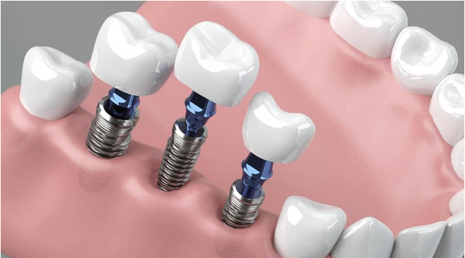 Three dental implants with crowns