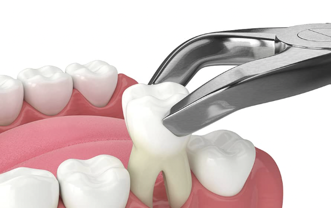 Tooth extraction with forceps