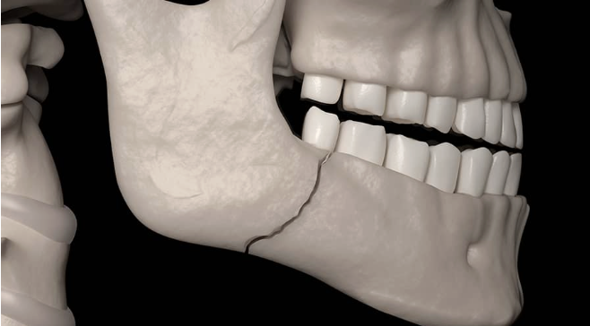 Mandibular fracture illustration